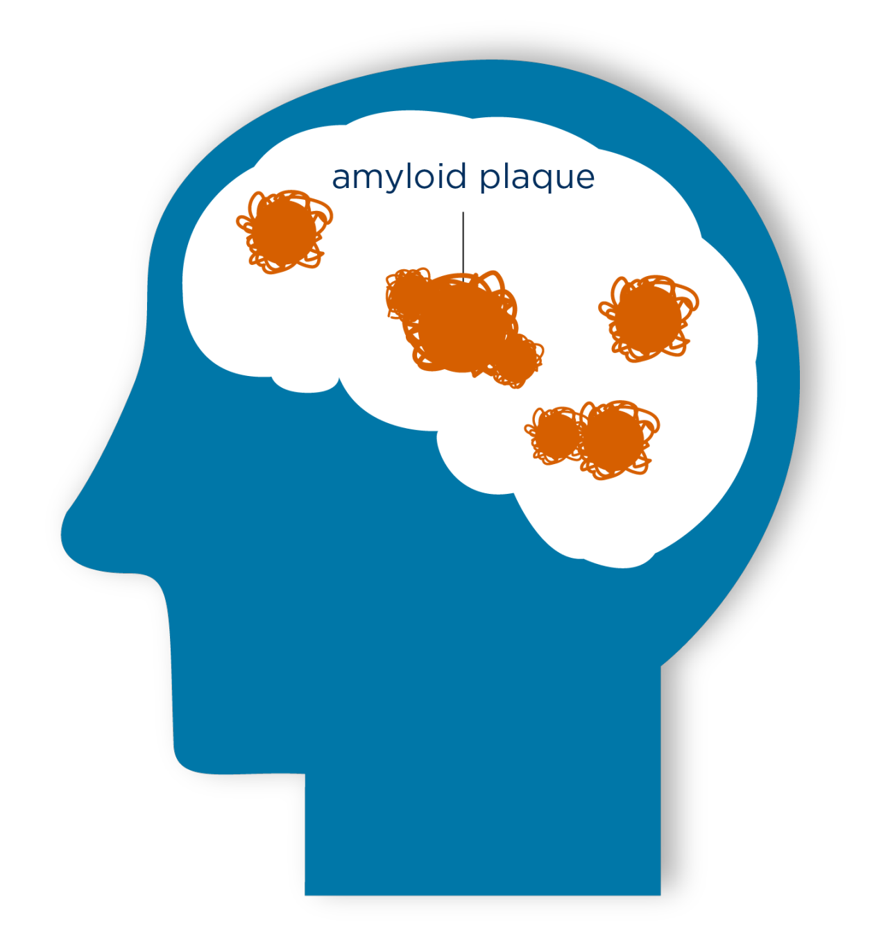 Illustration representing amyloid plaques building up in the brain